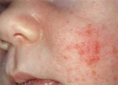 تاول پوست و صورت تاول پوست و صورت