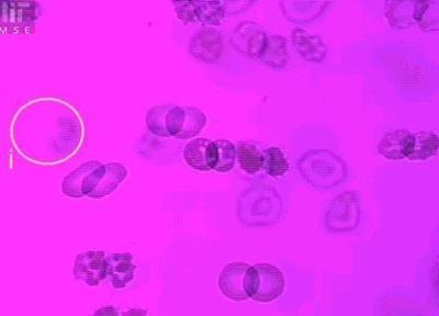 حقایقی درباره کم خونی حقایقی درباره کم خونی